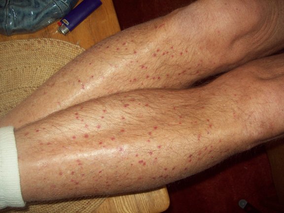 Red spots on legs and they're spreading - I cannot get a ...