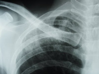 deteriorarea radiografiei articulației încheieturii
