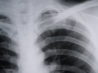 deteriorarea radiografiei articulației încheieturii unguent comun de tot felul