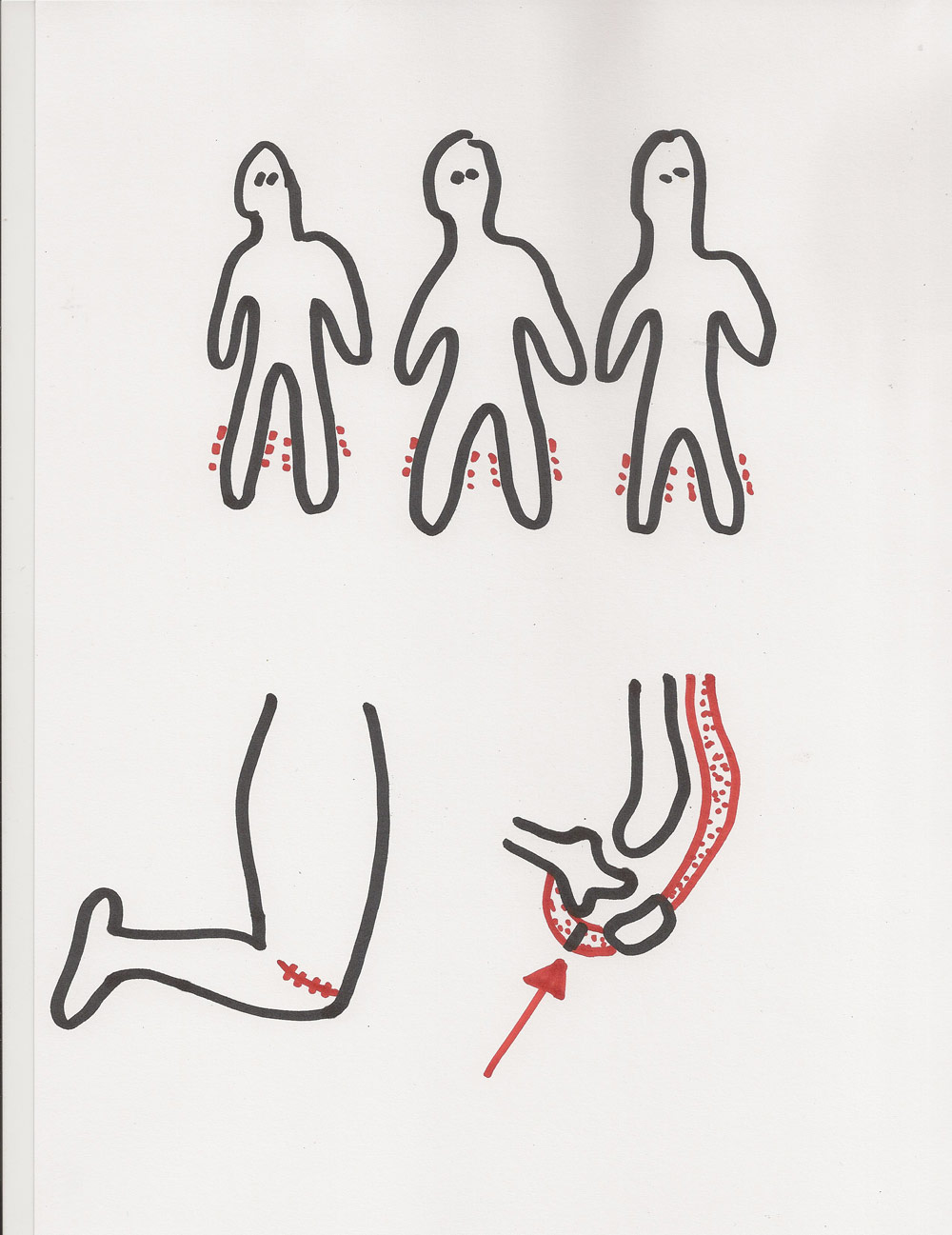 Человеческая многоножка схема сшивания