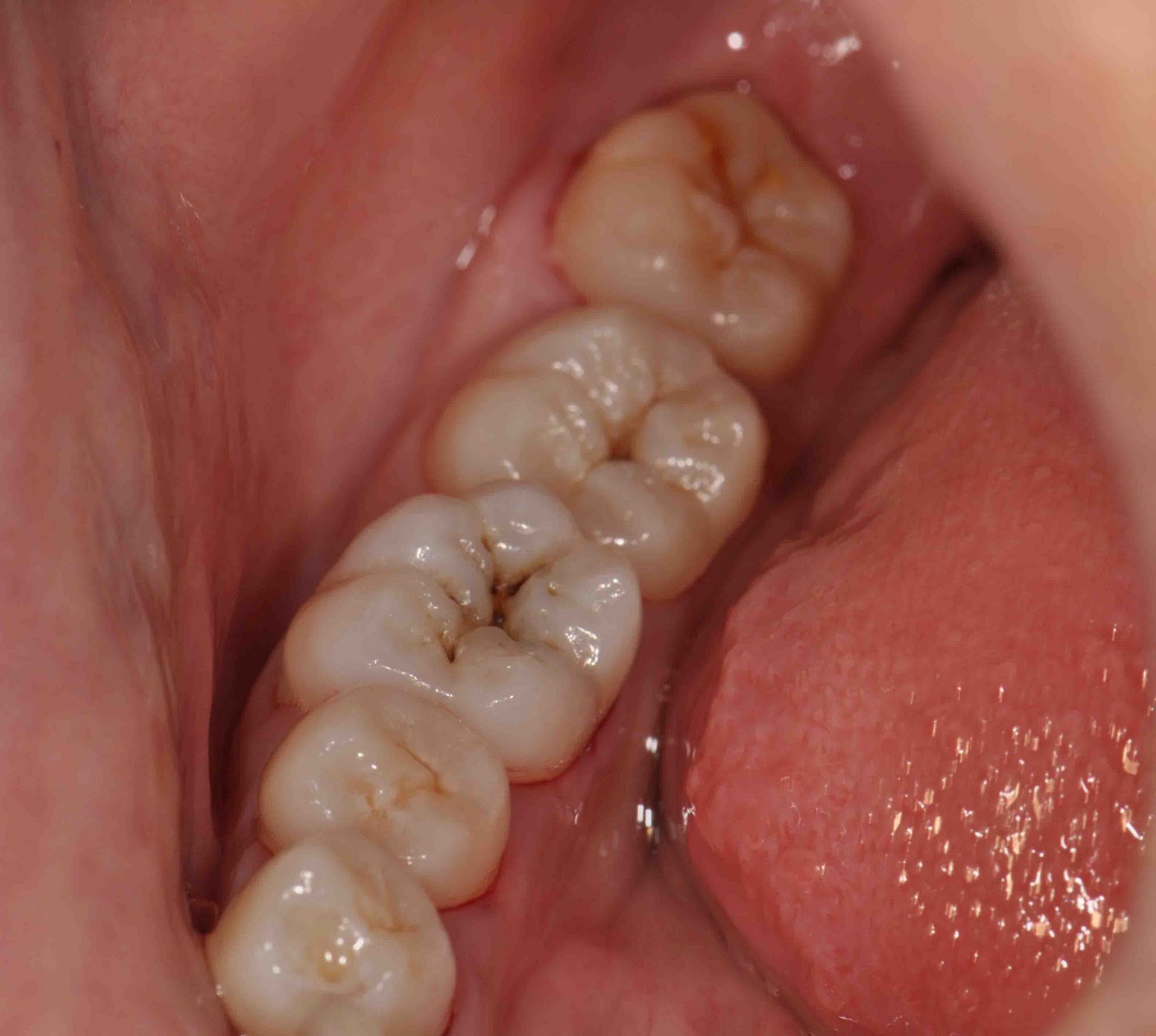 Treatment Options Dental Aesthetic With White Filling Ii On Back Teeth