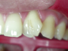 Dientes geminados