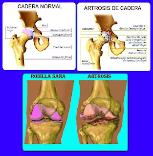 Arthrose du coureur 1