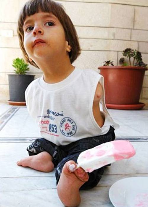 дети рождались без конечностей