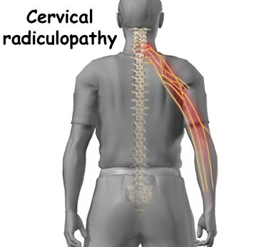 [cervical_radiculopathy.jpg]