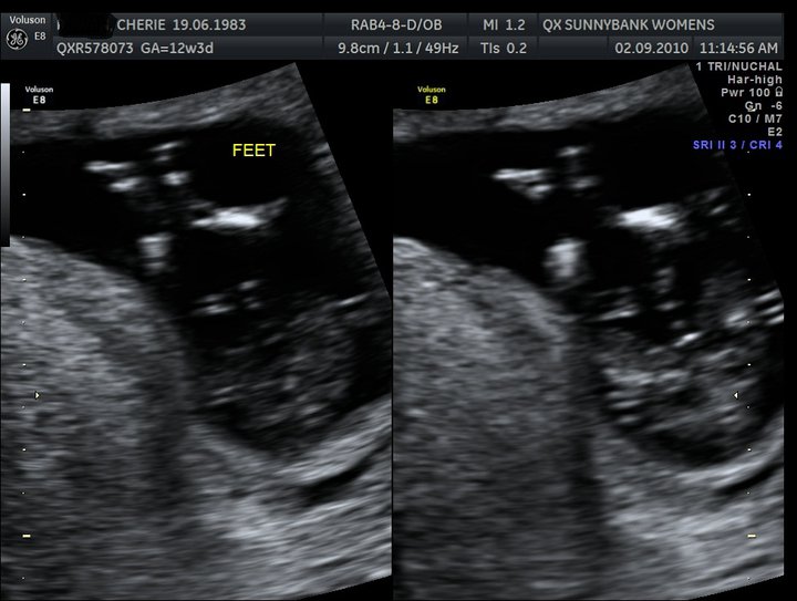 Cherie's Place: Scan's and update ~14weeks~