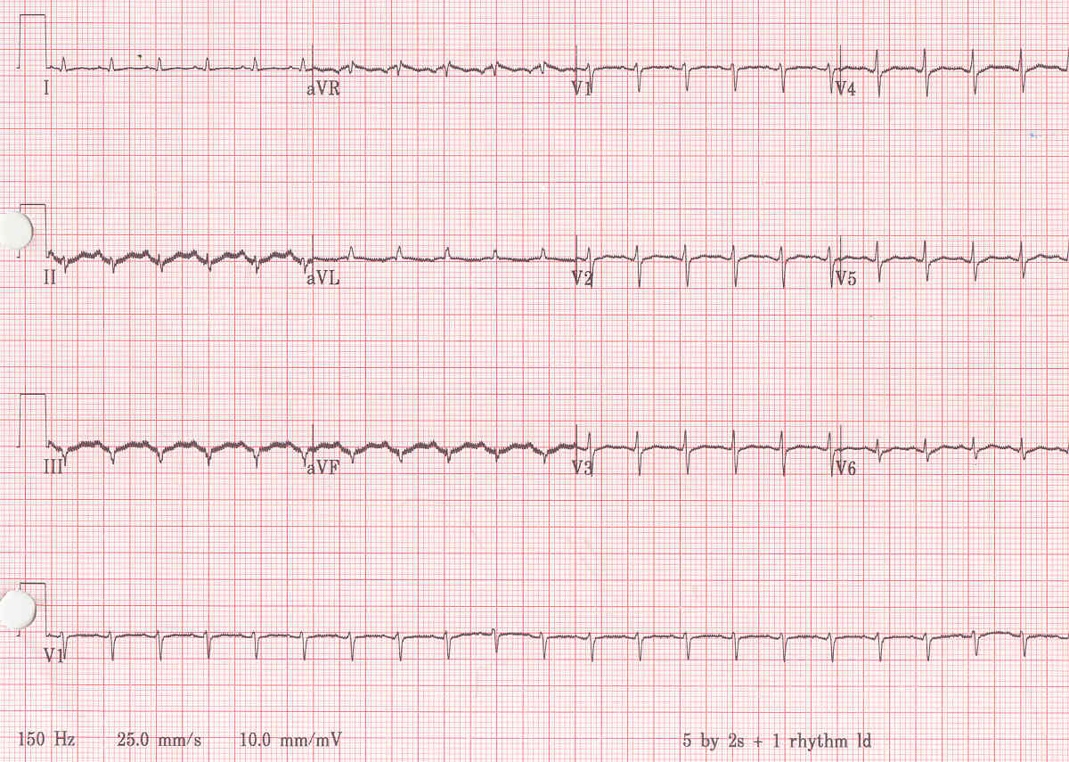 What Causes Low Voltage On Ekg