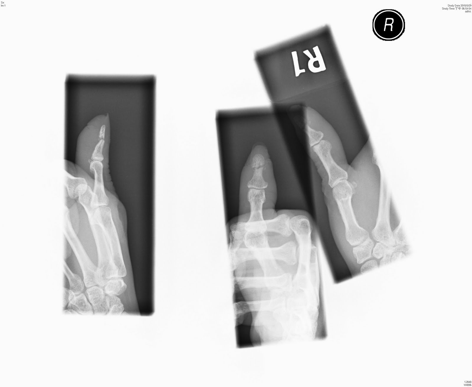 Big Bad Fingertip crushing injury with pulp atrophy