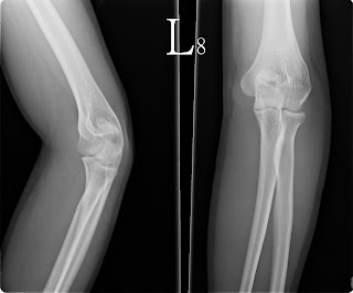 left olecranon fracture left olecranon fracture