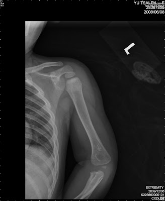Big Bad: 1 year-old supracondylar fracture of humerus