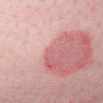 ringworm doesn t itch ringworm doesn t itch