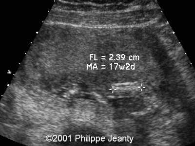 Aneuploidías Trisomía 16