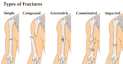 Sprains and fractures: prevention and first aid ~ Pinoy Mountaineer