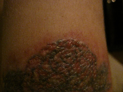 Chronicles of a Tattoo Removal: Day 4.Bumps!