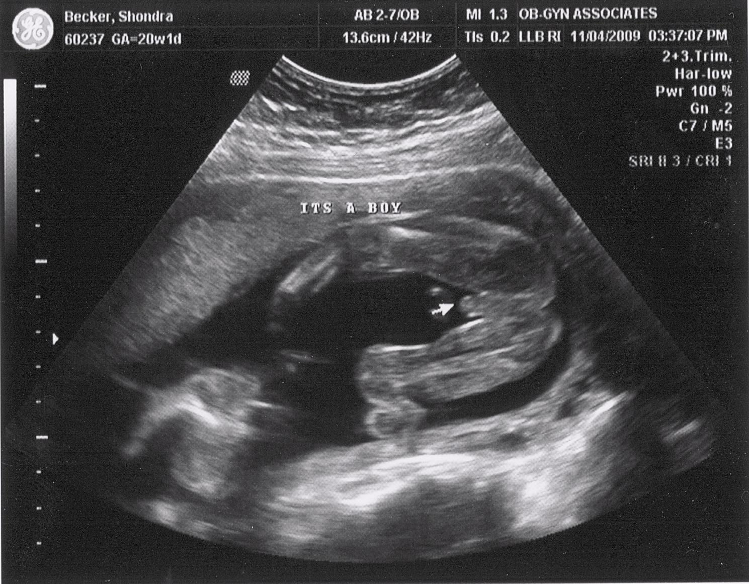 Ultrasound Pictures 26
