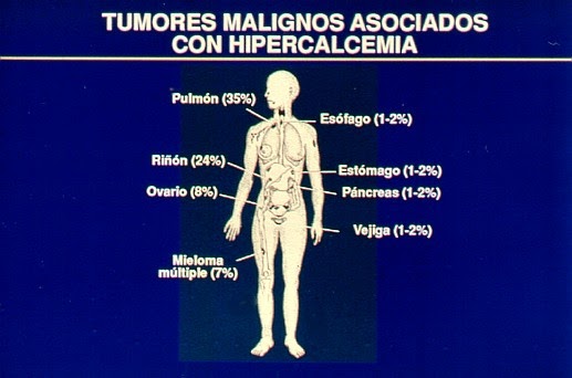 síndrome de cáncer de próstata paraneoplásico