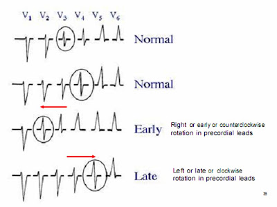 Extreme Counterclockwise Rotation Ecg Counterclockwise Rotation 心電図, 心電図 反時計回転 意味 – DEMWSJ