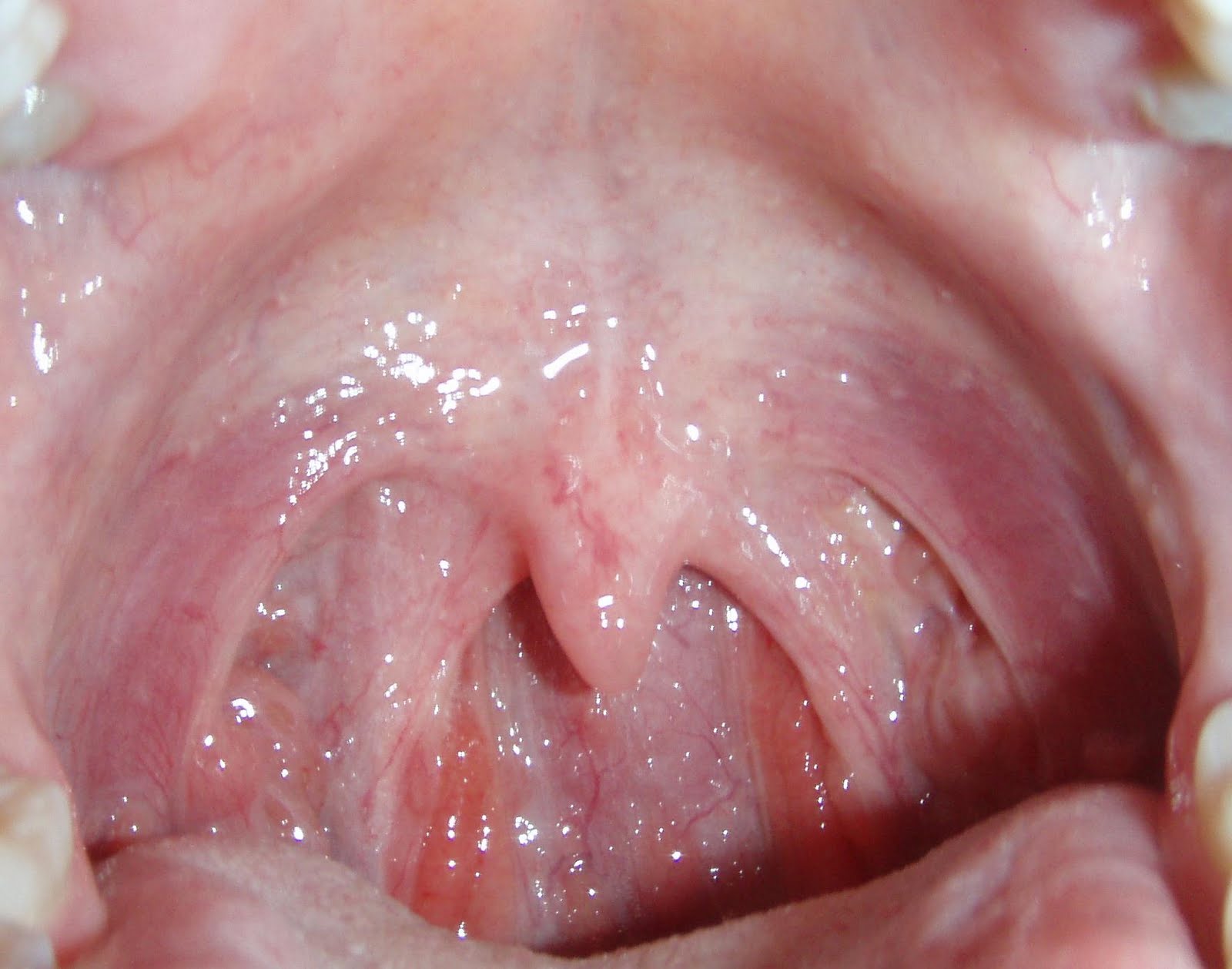 Normal Throat Picture 13