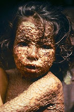 Child with smllpox, Bangladesh