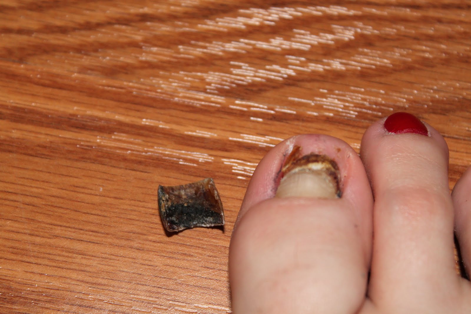 The World According To Rachel Gross, my toenail fell off....EWWW!!!!