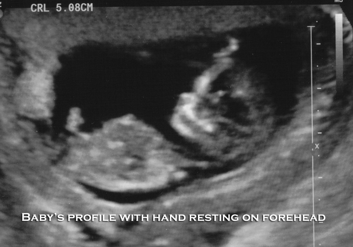 Baby Ultrasound Baby Ultrasound At 11 Weeks
