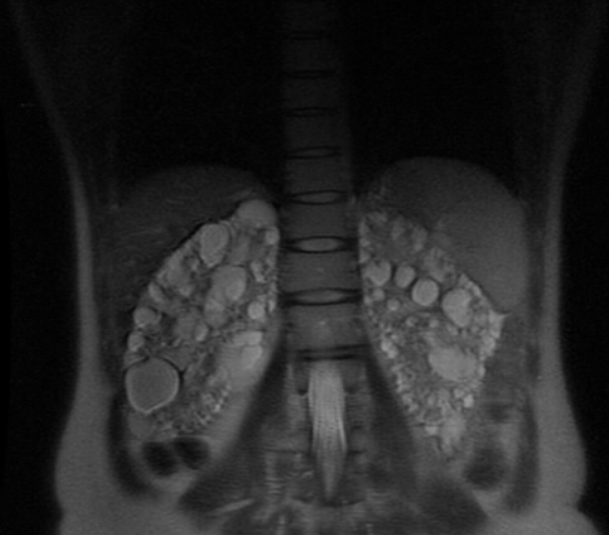 Polycystic Kidney Disease with Chronic PancreatitisCT & MRI Sumer's