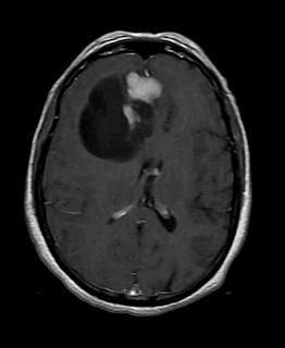 Supratentorial Hemangioblastoma-MRI - Sumer's Radiology Blog