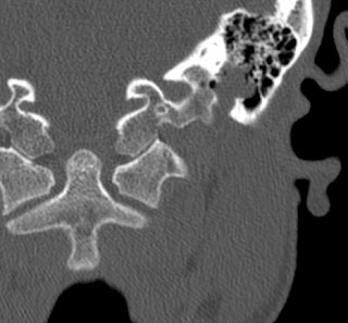 Facial Neuroma 90