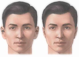 [kepce_kulak_estetigi.jpg]