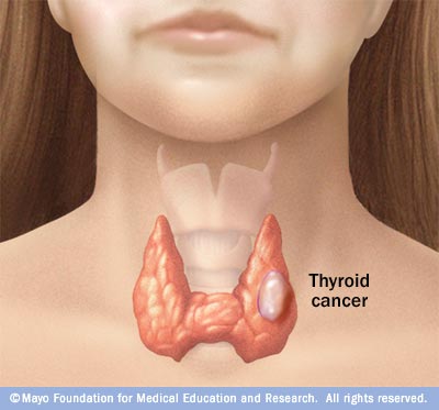 thyroid cancer goiter healthy welcome