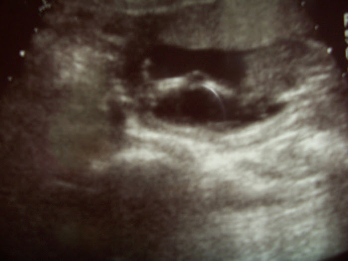 13 Weeks Sonogram 4