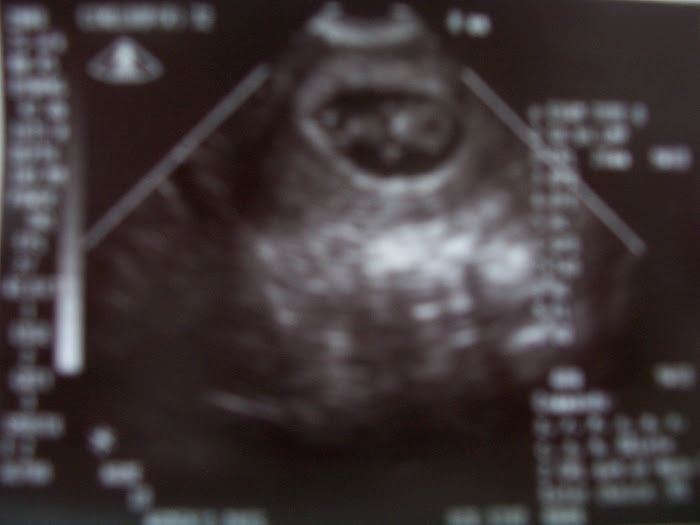 9 Weeks Sonogram 2