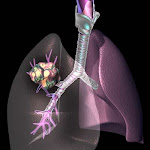 RADON in flyash, lung cancer