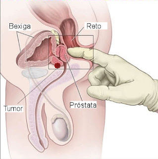Próstata - toque retal