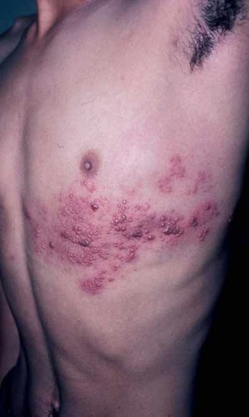 Herpes Zoster Photos - Dermatology Education