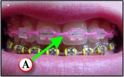 Orthognathic Surgery and Braces: Power chain and new archwires