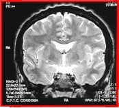 corte es verticis gyrata síntomas de diabetes corte es verticis gyrata síntomas de diabetes