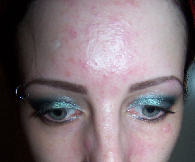 Oh My Gosh: Face of the Day: Acute Allergy, What does it look like? Makeup Allergic Reaction