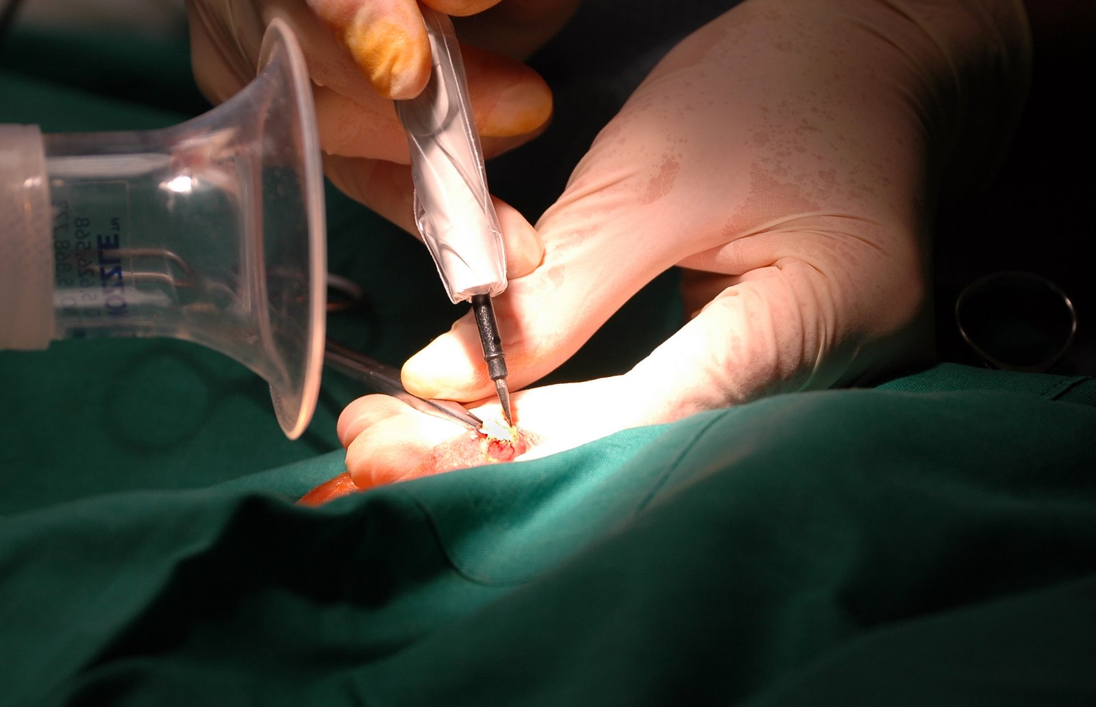 [vasectomy-26.jpg]