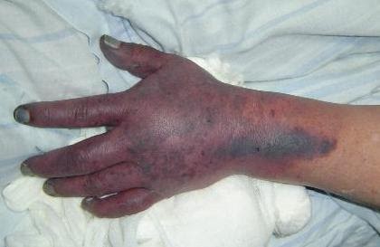 enfermedad purpura imagenes enfermedad purpura imagenes