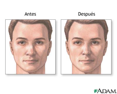 procedimientos medicos en trauma: FRACTURA NASAL