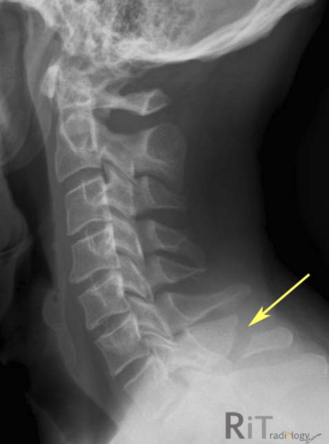Megan's CT/MRI Pathology: Clay Shoveler's Fracture