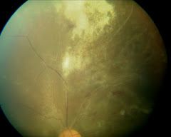 CMV retinitis