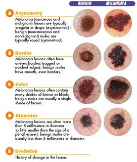melanoma characteristics