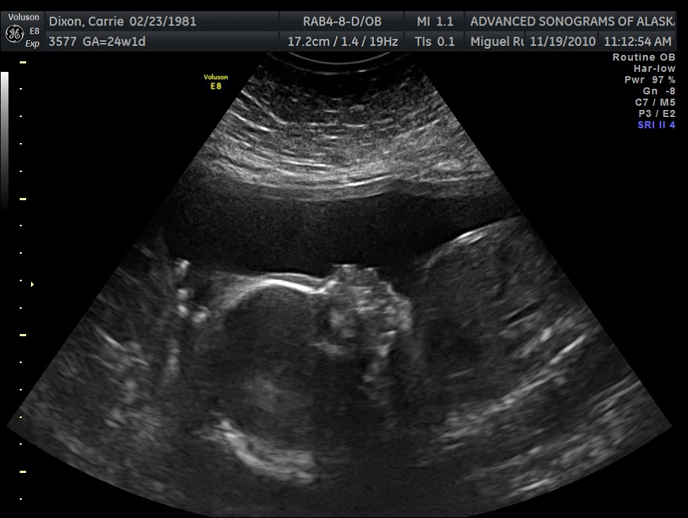 Connor Joseph Casey 24 week ultrasound and echo