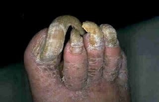ugly%2Bfeet-1.jpg