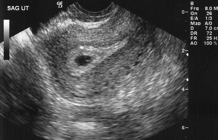 Беременность 5 недель фото. УЗИ 4 недель беременности УЗИ. УЗИ беременности 2.5 недели. УЗИ на 2-4 недели беременности. УЗИ 2.5 недели беременности фото.