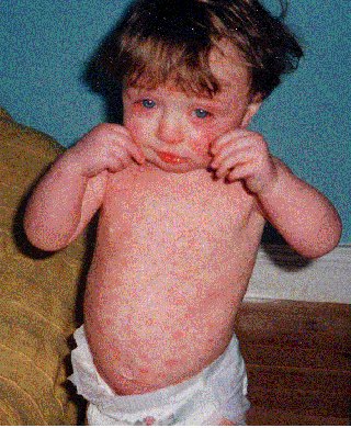 Measles - KidsHealth