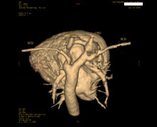 ARC AORTIQUE PATHOLOGIQUE NOUVEAU-NE