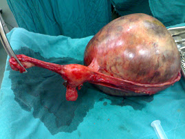 Lt. Ovarian Tumor